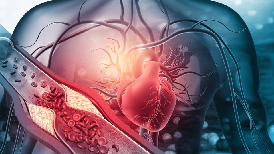 Marcadores Cardíacos y Riesgo Cardiovascular: ¿Más Allá del Infarto? | Grupo i2